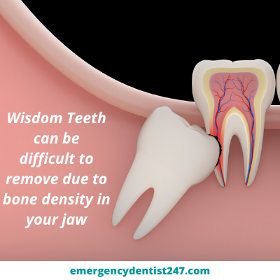 Do-Wisdom-Teeth-Always-Need-to-be-Removed-ed247