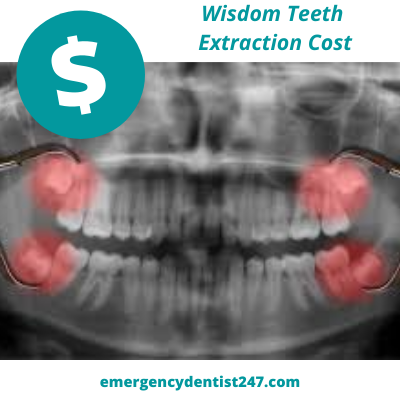 How-Much-Can-a-Wisdom-Tooth-Extraction-Cost-ed247