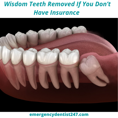 How-To-Get-Your-Wisdom-Teeth-Removed-If-You-Dont-Have-Insurance-ed247